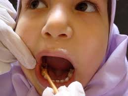 امار بالای پوسیدگی دندان در بین کودکان
