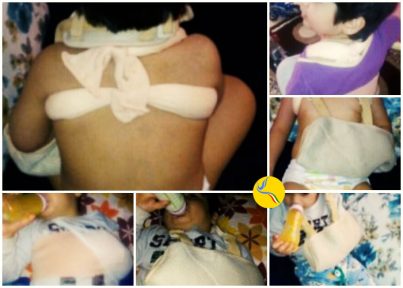 شکستگی استخوان ترقوه کودک سه ساله در پی رفتار خشونت آمیز مربی مهدکودک