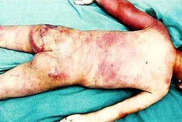 کودک‌آزاری در کرمانشاه؛ سوزاندن نوزاد سه ماهه با سیگار و شیء داغ از سوی والدین