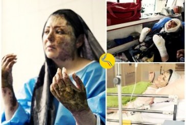 اسیدپاشی در تبریز؛ «مریم در اسید سوخت»